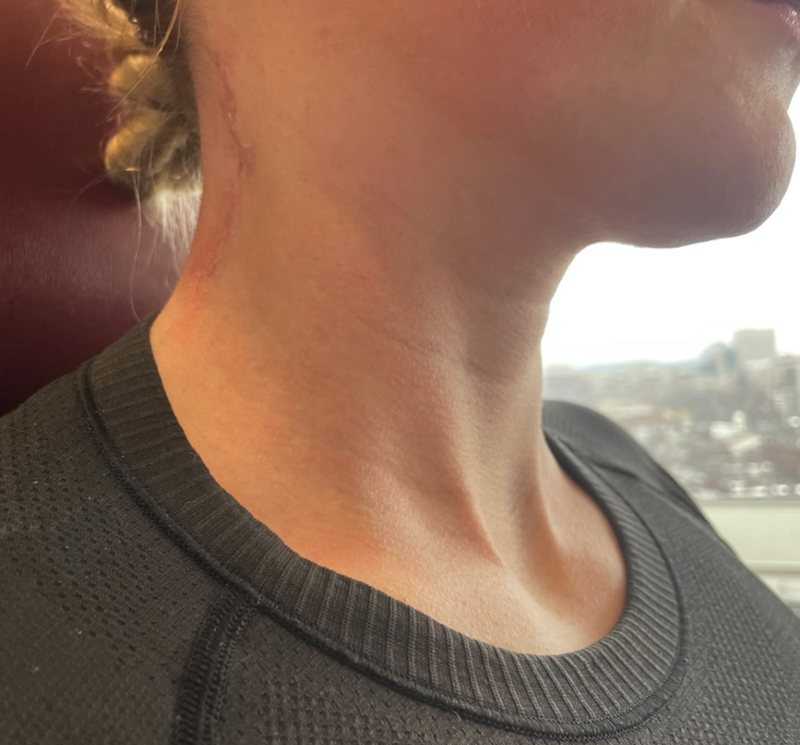 Side view of a patient's neck showing a healing incision behind the ear along the hairline