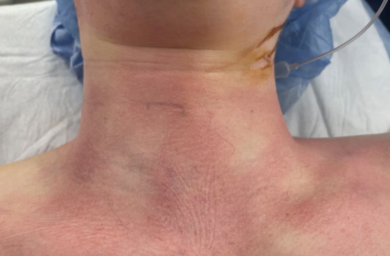 Front of a patient's neck after robotic thyroid surgery, with bruising and no incision