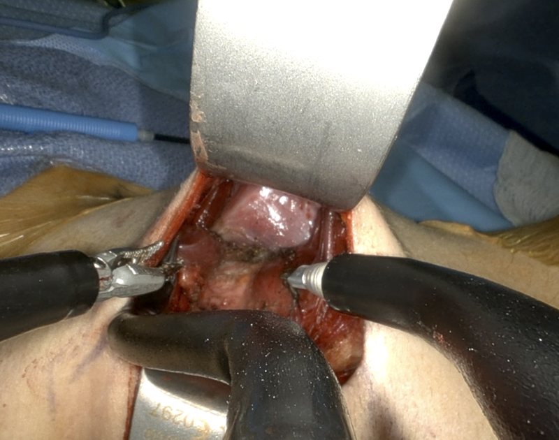 Operating view of robotic instruments working through the incision behind the ear